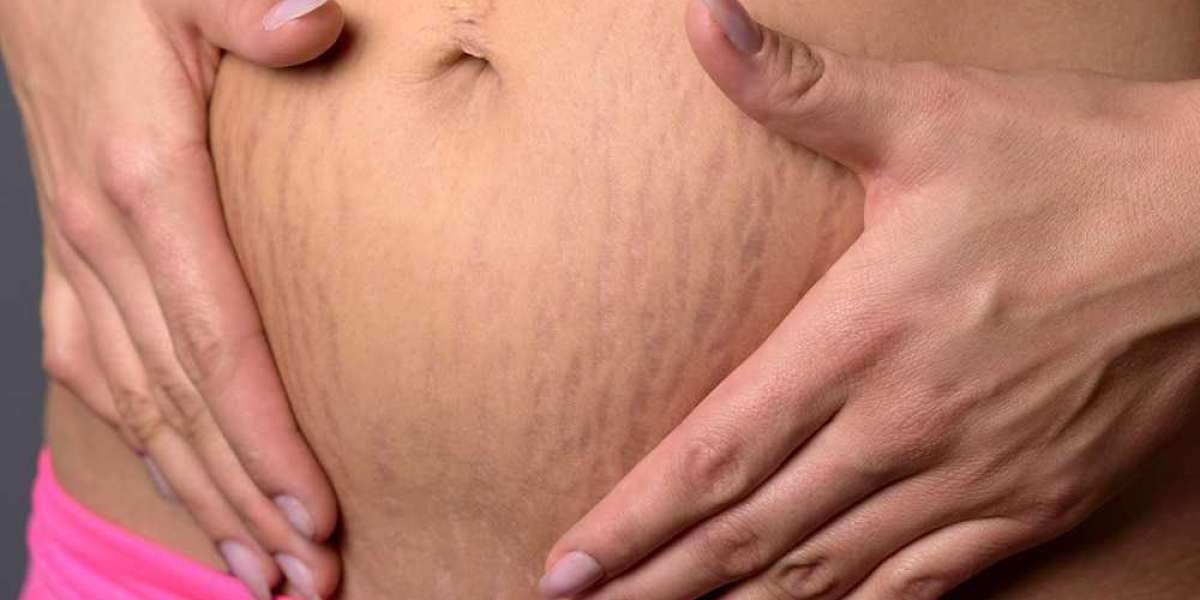 Effective Stretch Marks Treatment Southampton: Your Path to Confidence